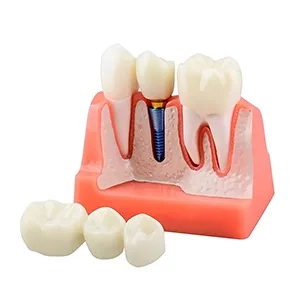 مولاژ ایمپلنت تاج و بریج دندان