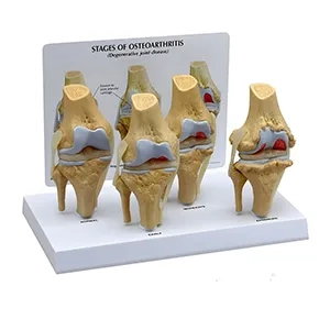 مولاژ بیماریهای زانو
