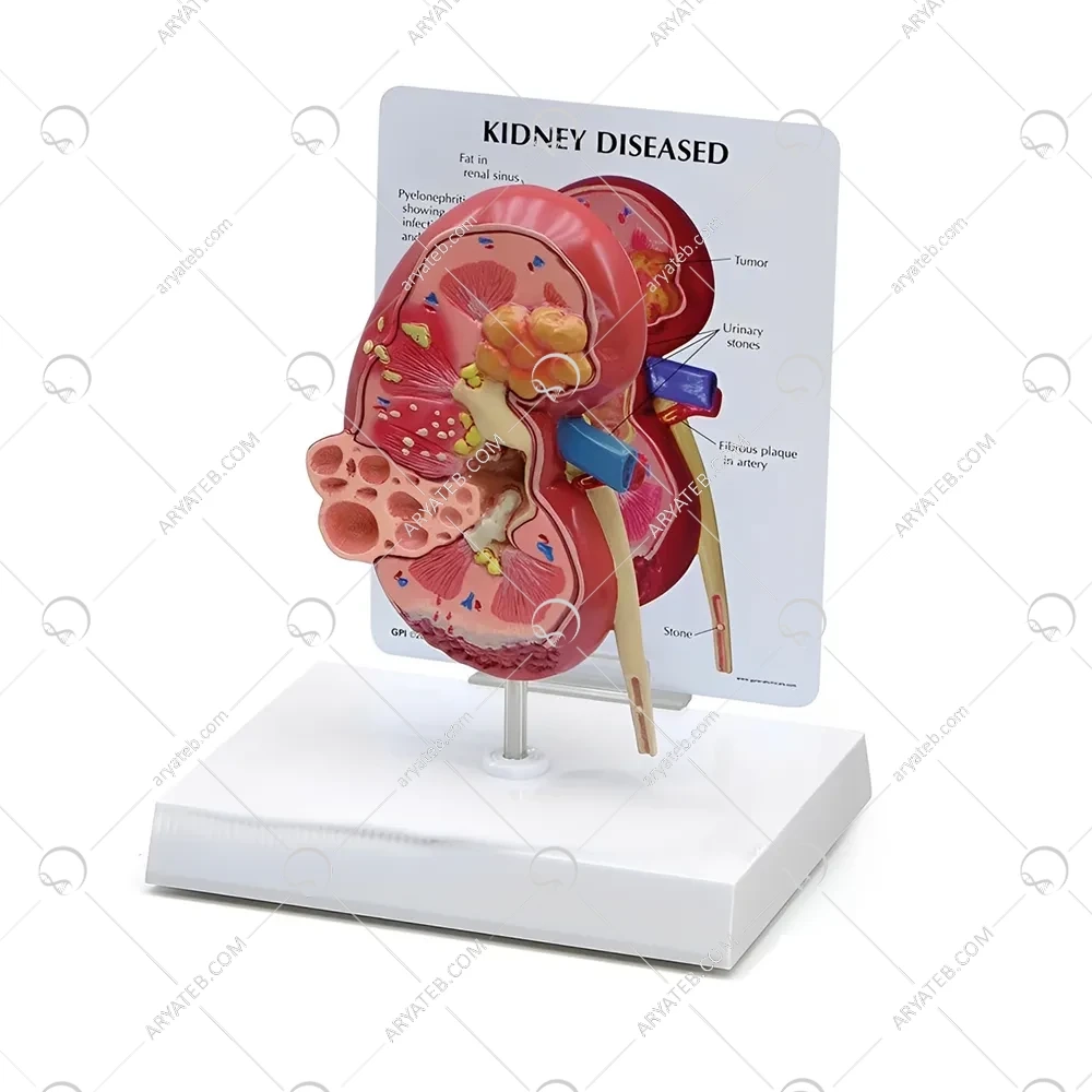 مولاژ بیماری های کلیه