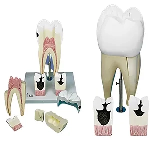 مولاژ اولین دندان آسیاب بزرگ فک تحتانی