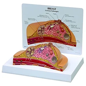 مولاژ پاتولوژی پستان