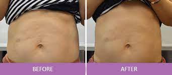 دستگاه هایفو دابلو