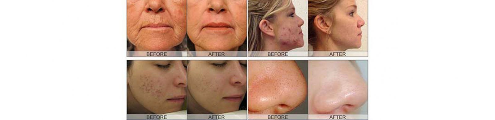 دستگاه میکرودرم ابریژن