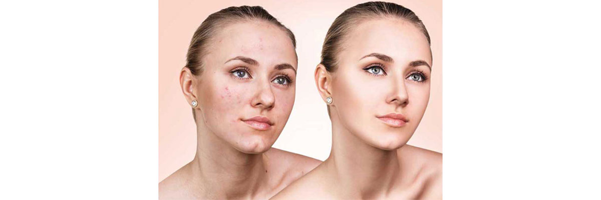 دستگاه هیدرودرمی هاینس