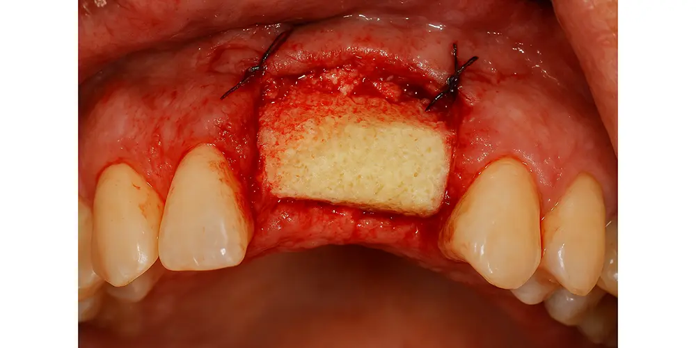 بی کورتیکال کنسلوس استریپ بلاک مینرال FDBA