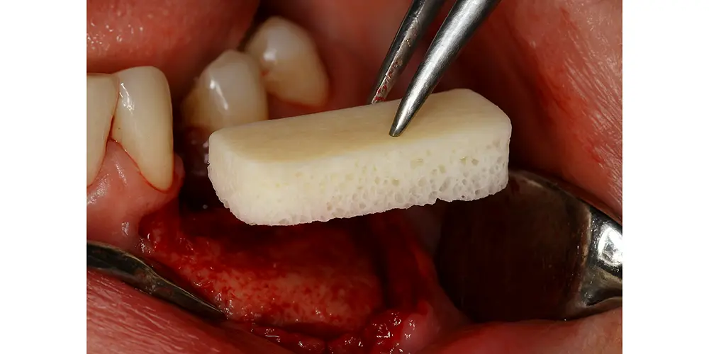 کورتیکو کنسلوس استریپ بلاک مینرال FDBA